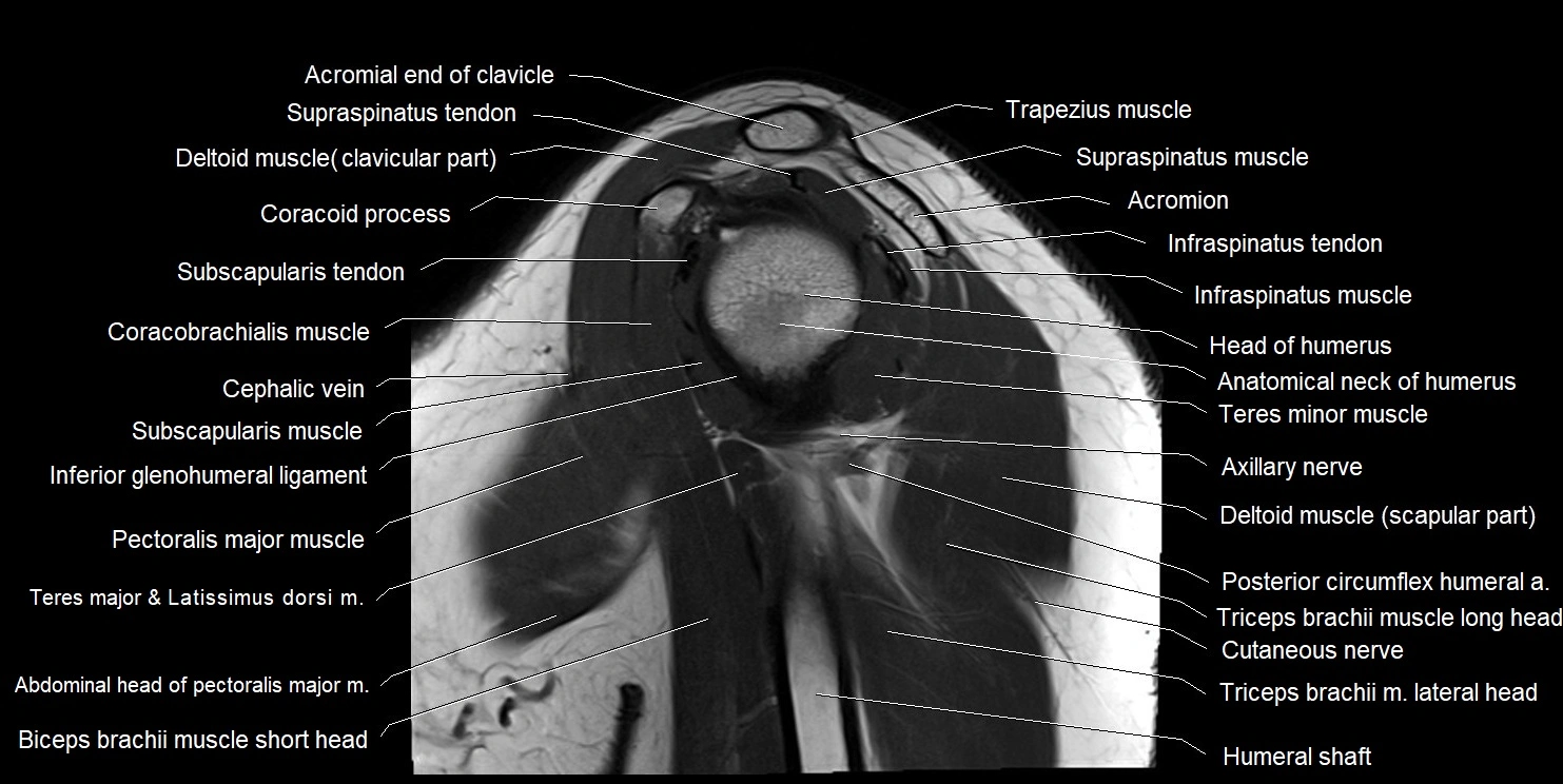 mri shoulder sagittal cross sectional anatomy image 9.webp